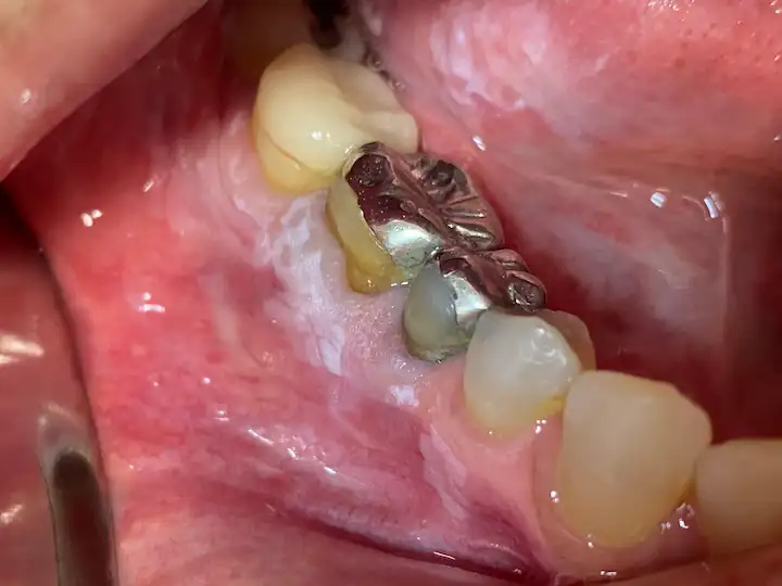 Como Prevenir o Câncer Bucal Cuidados Essenciais para a Saúde da Sua Boca