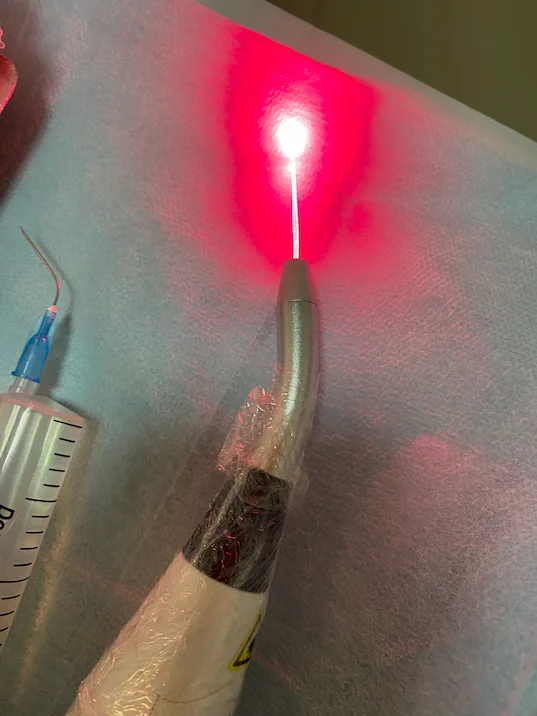Uso de Laser na Odontologia: Tecnologia a Favor do Sorriso